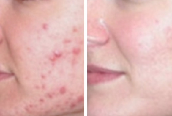 POWER DPL + RF nowa generacja IPL Elight