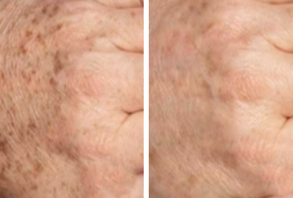 POWER DPL + RF nowa generacja IPL Elight