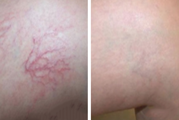 POWER DPL + RF nowa generacja IPL Elight