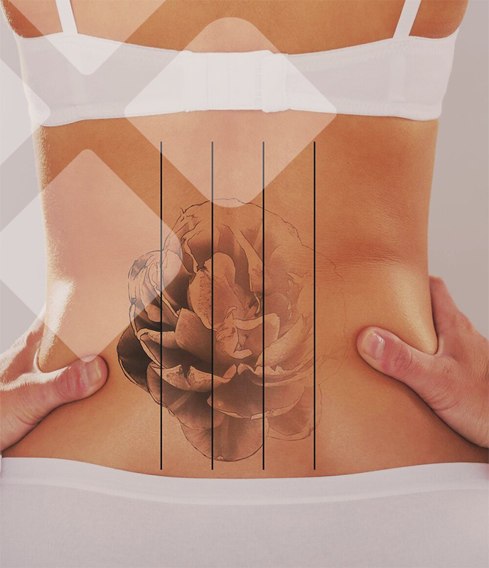 Czynniki wpływające na efekty laserowego usuwania owłosienia